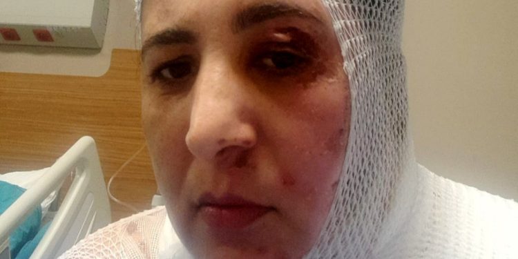 Adana’da, üvey oğlu kezzapla saldırdı